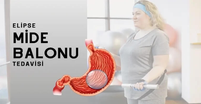 Yutulabilir Mide Balonu Fiyat: 2025’te Nelere Göre Değişir?