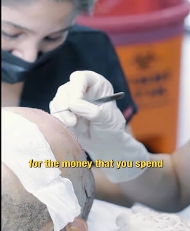 Hair Transplant Antalya – Haarex Clinic